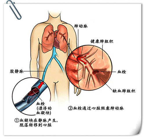 血栓图血angle79高吗图片