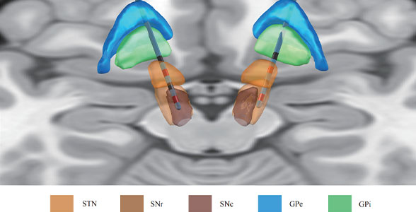 成果发表｜高频STN+超低频SNr双靶点DBS改善帕金森病冻结步态